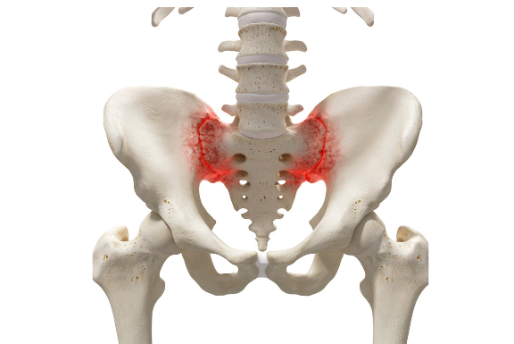 Pelvic inflamation photo